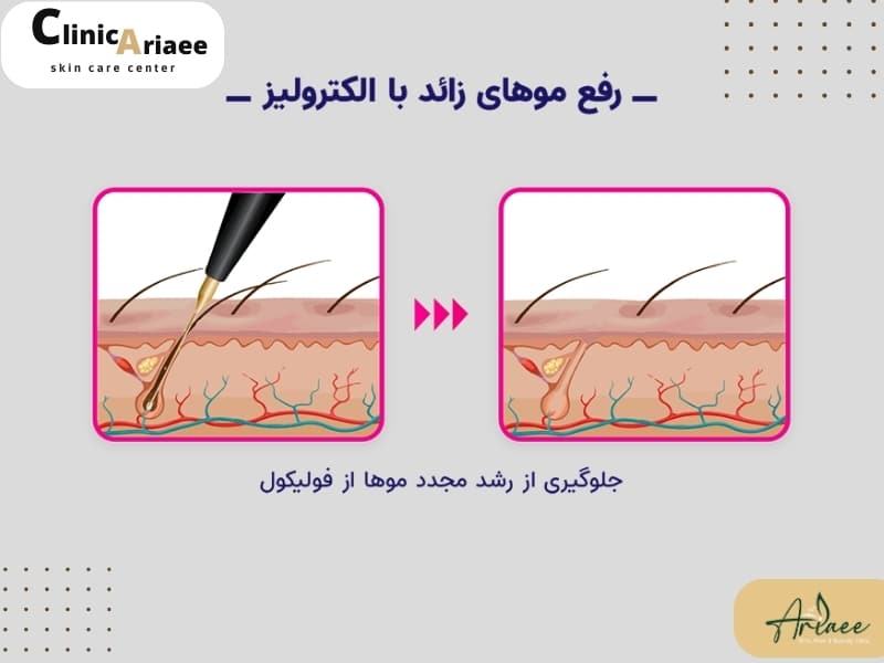 تفاوت بین لیزر موها و الکترولیز در چیست؟