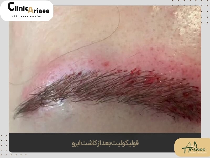راه‌های درمان جوش بعد از کاشت ابرو