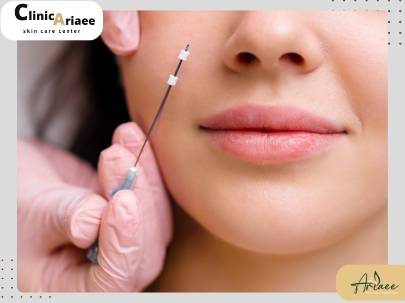 ویژگی‌ها و خصوصیات انواع نخ لیفت