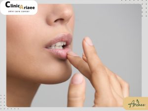 خشکی لب‌ها بعد از تزریق ژل