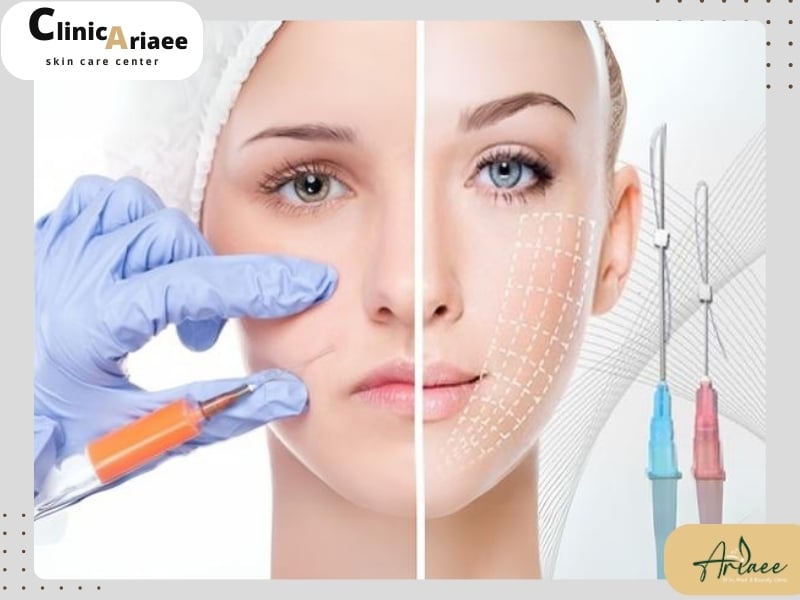 تزریق چربی بهتر است یا لیفت نخ