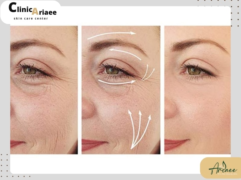 نتایج ظاهری لیفت صورت در مقایسه با تزریق چربی