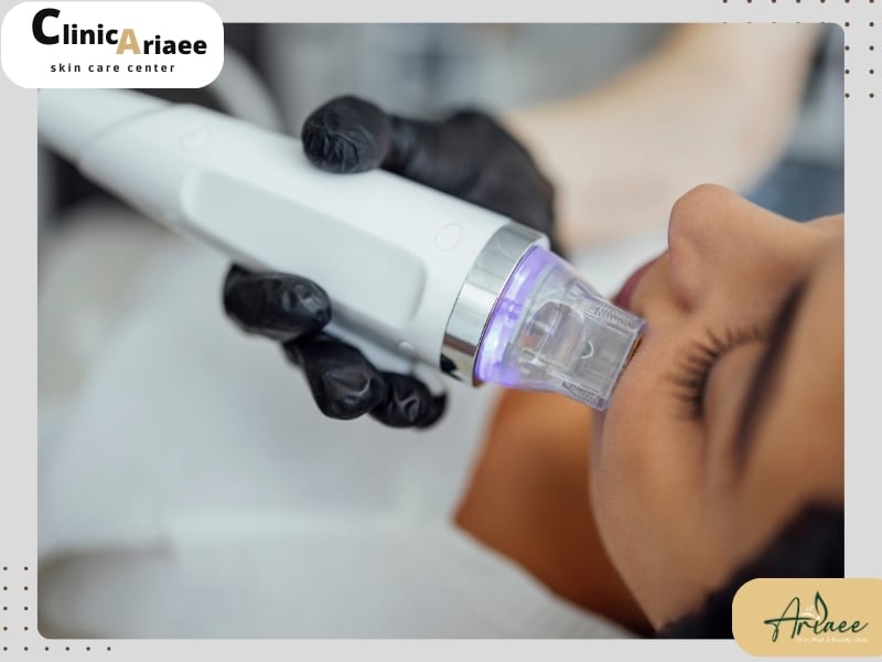 سابسیژن بهتر است یا میکرونیدلینگ؟
