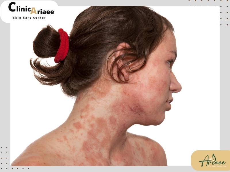 علل ابتلا به درماتیت نومولار