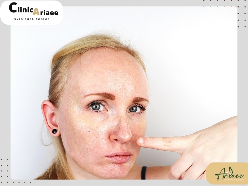 راههای پیشگیری از ابتلا به درماتیت سبوره