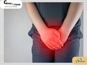 لیزر زگیل تناسلی
