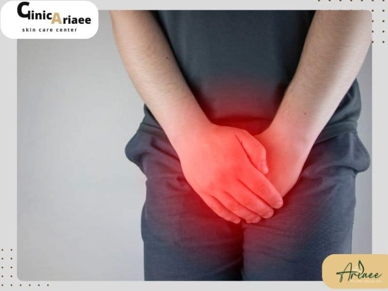 لیزر زگیل تناسلی