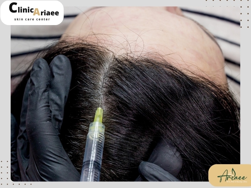 سن مناسب مزوتراپی مو چه سنی است؟
