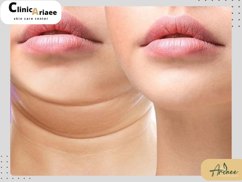 کاربرد مزوتراپی غبغب