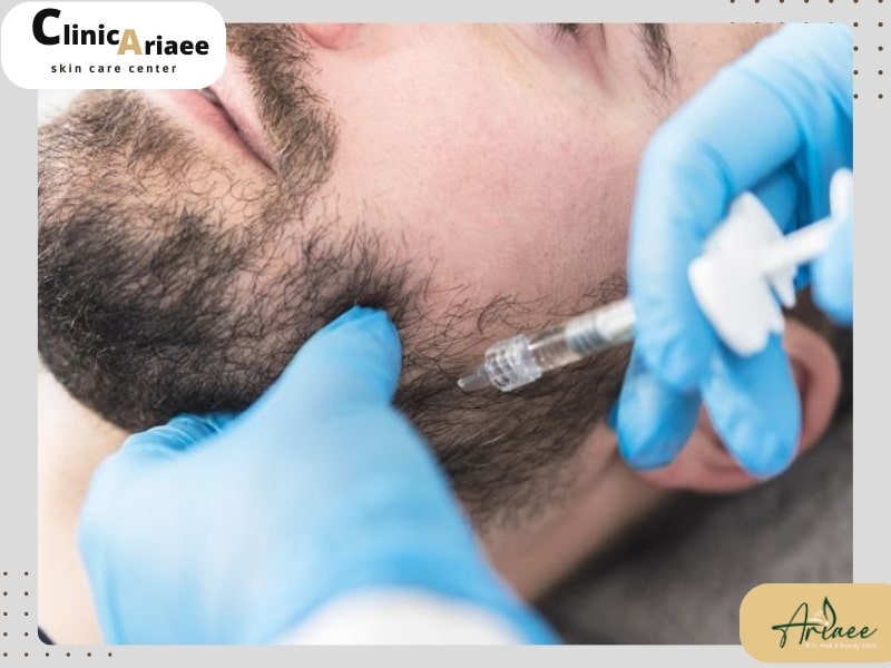 عوارض مزوتراپی ریش