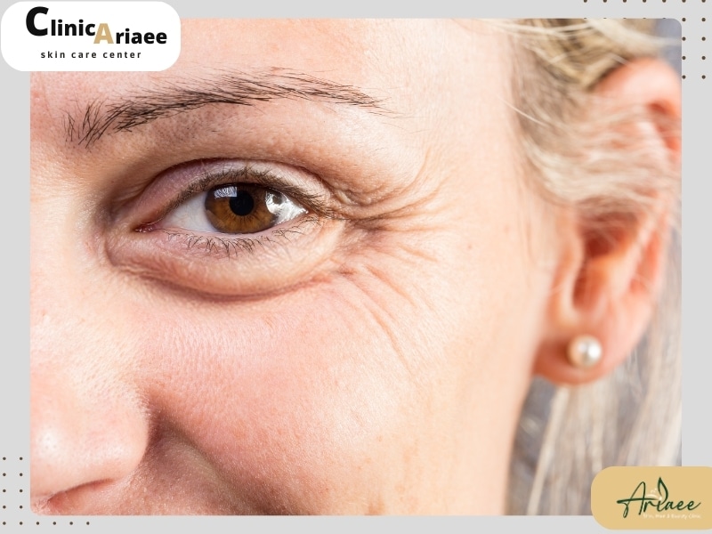 چه زمانی عوارض سابسیژن بیشتر می‌شود؟