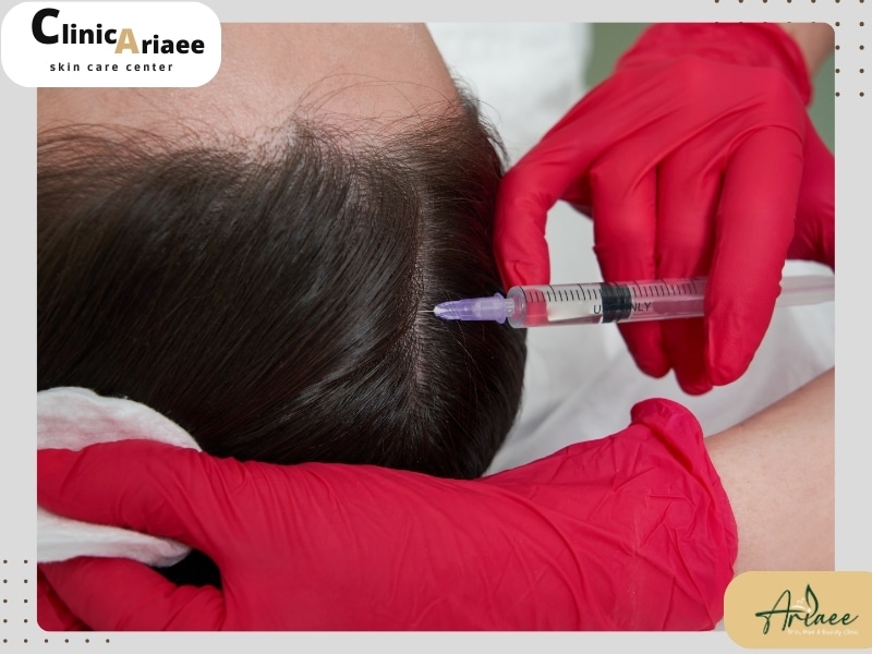 عوارض مزوتراپی مو در بلند مدت