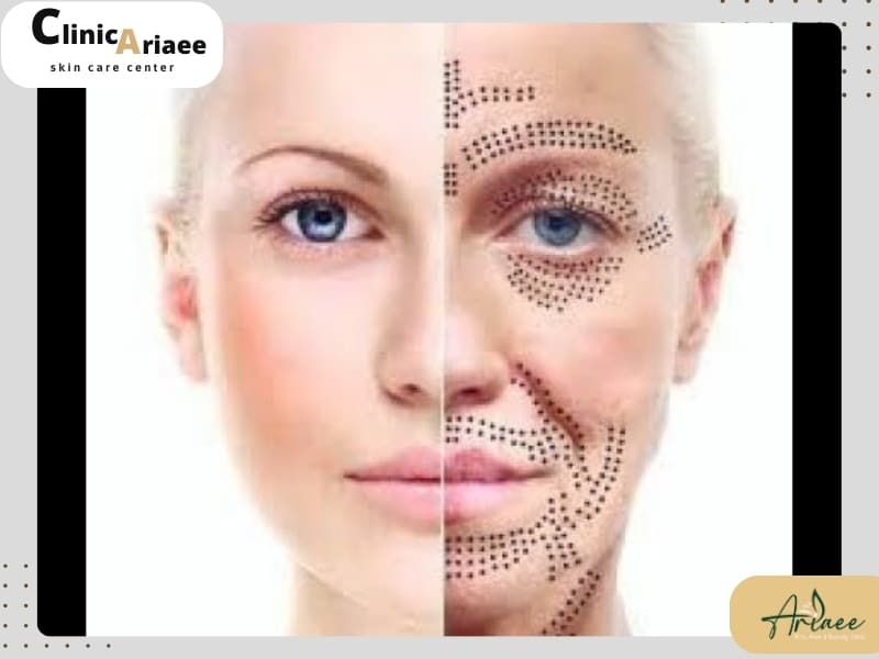 پلاسماتراپی برای چه افرادی مناسب است؟