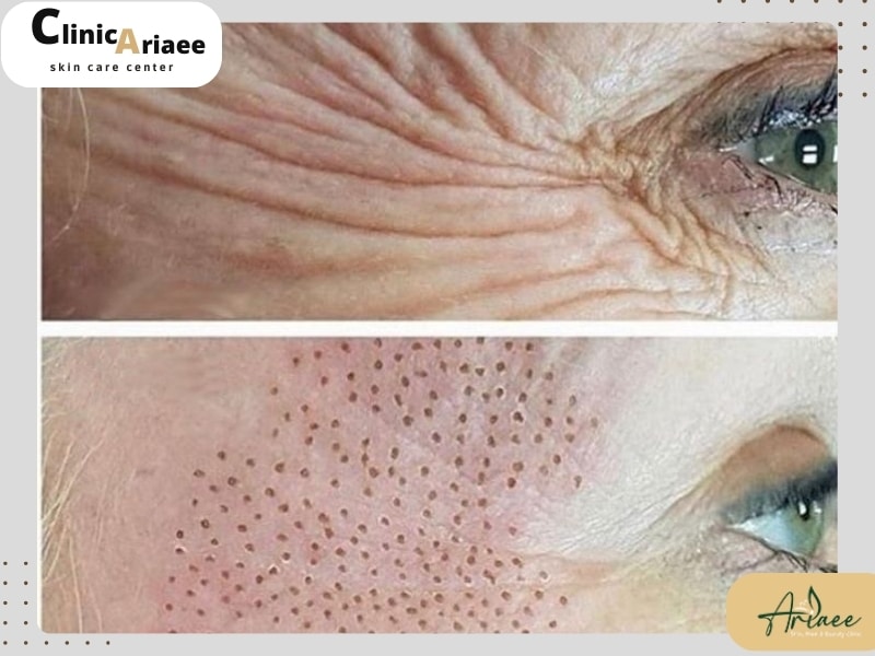 عوارض پلاسماتراپی
