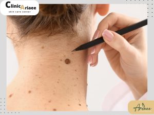 برداشتن خال