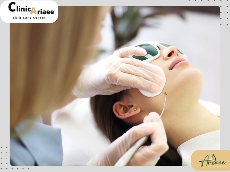 برداشتن خال برای چه افرادی مناسب است؟