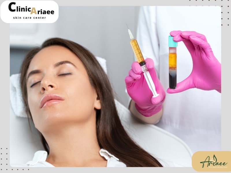 مزایا و فواید prp صورت