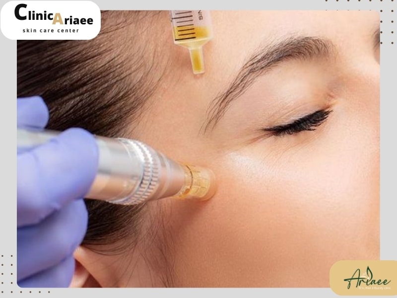 روش انجام prp صورت( پی آر پی صورت چگونه انجام میشود؟)