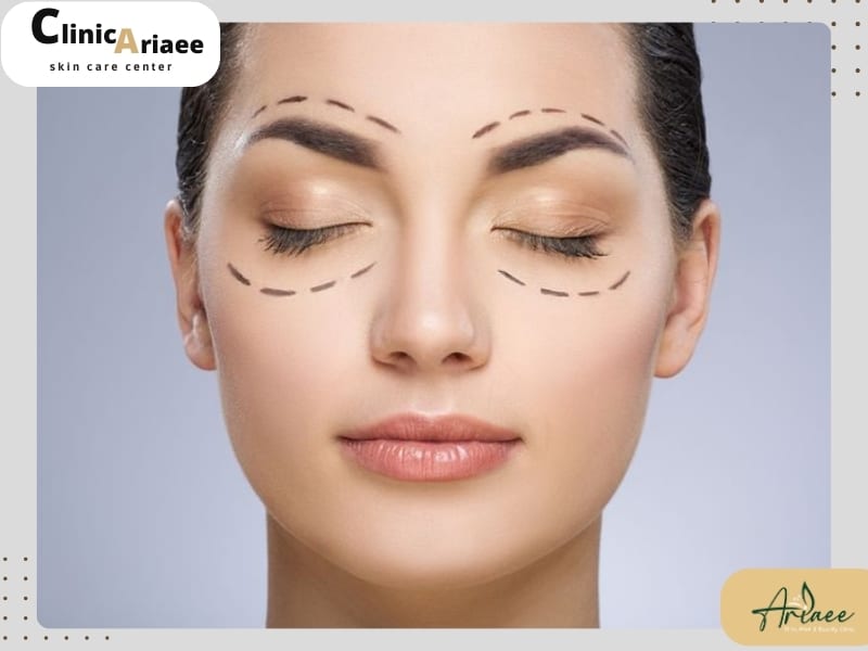 هایفوتراپی دور چشم برای چه کسانی مناسب است؟