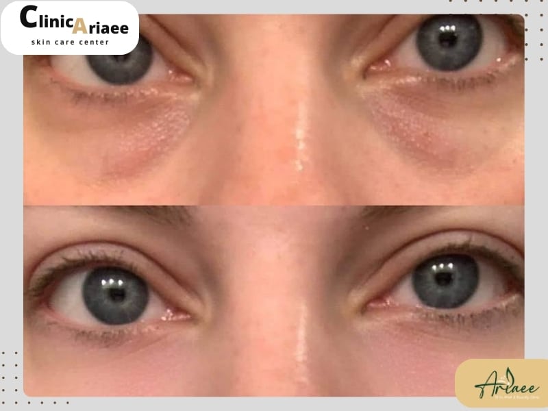 هزینه هایفوتراپی دور چشم
