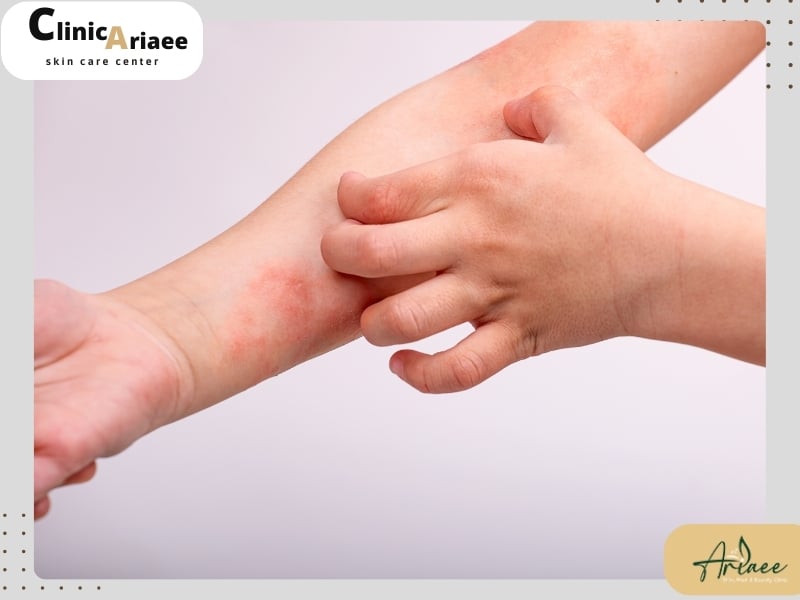 درماتیک آتوپیک( اگزمای آتوپیک) چیست؟