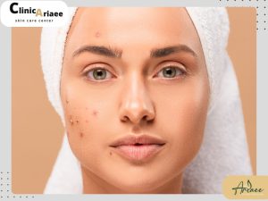 فرق سابسیژن و میکرونیدلینگ