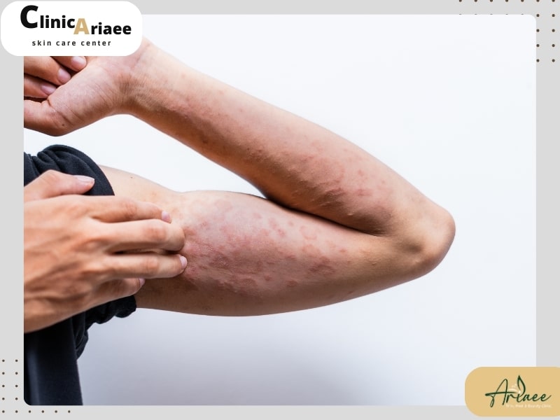 علل درماتیت آتوپیک