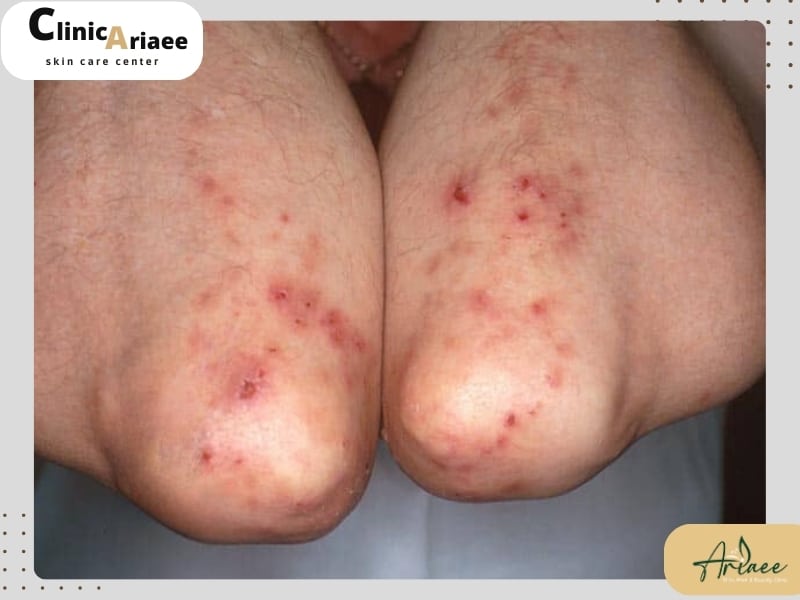 علل درماتیت هرپتی فرم