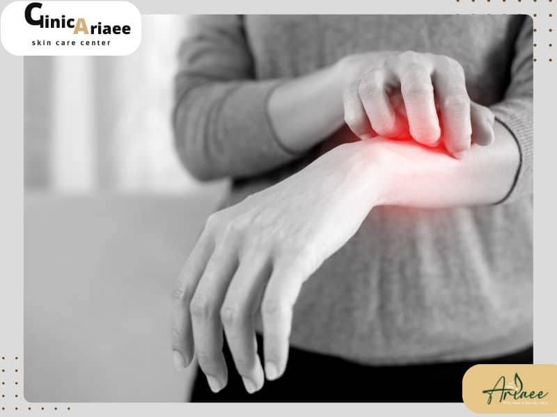 علائم قارچ پوستی