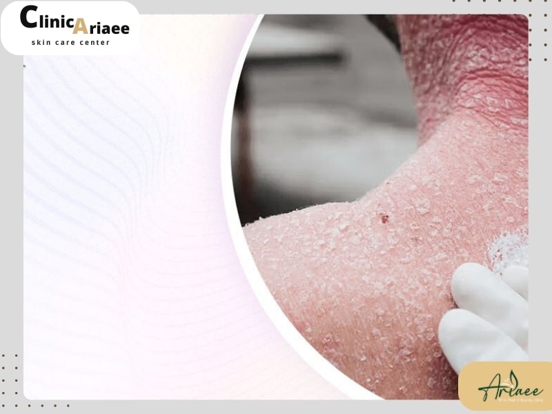 راه‌های تشخیص درماتیت اکسفولیاتیو