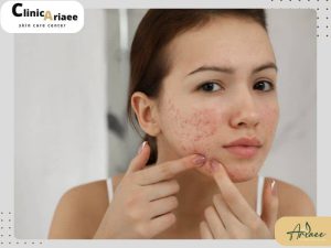 سابسیژن جای جوش