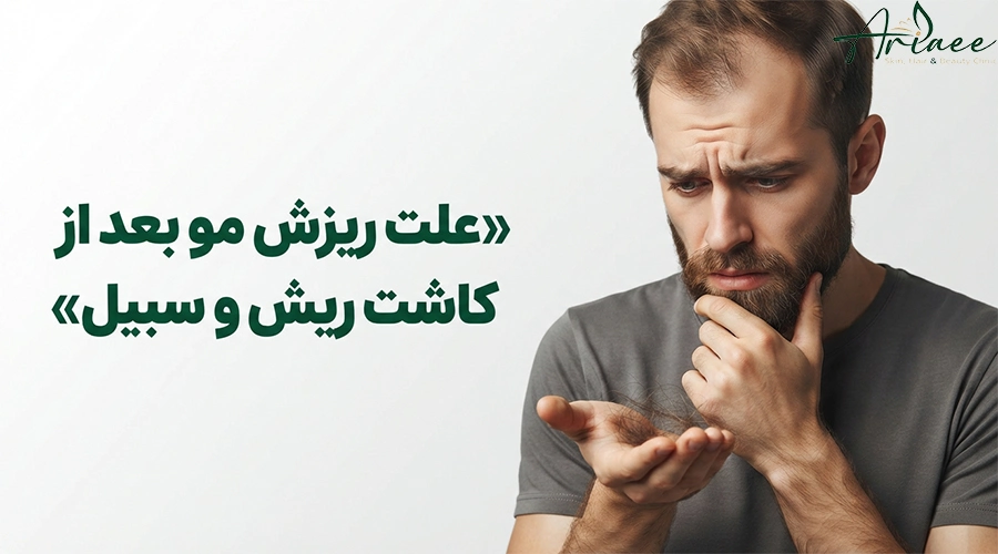 علت ریزش مو بعد از کاشت ریش و سبیل