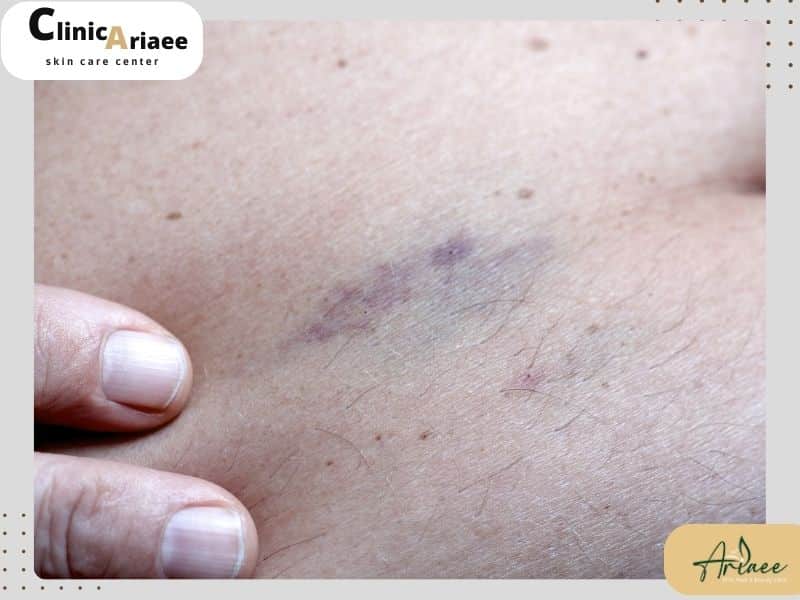 دلایل بروز کبودی پس از تزریق چربی