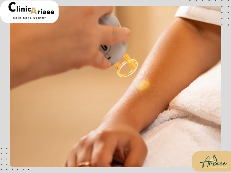 عوارض و نکات اصلاح بعد از اولین جلسه لیزر