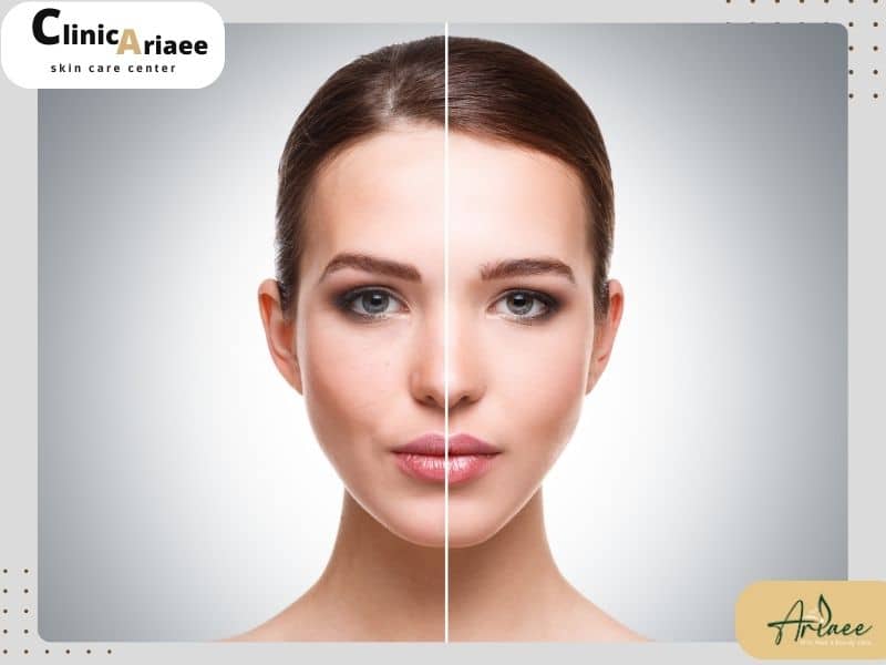  معایب و عوارض تزریق چربی به صورت