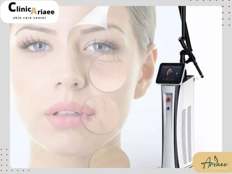مزایای استفاده از روش لیزر co۲ فرکشنال