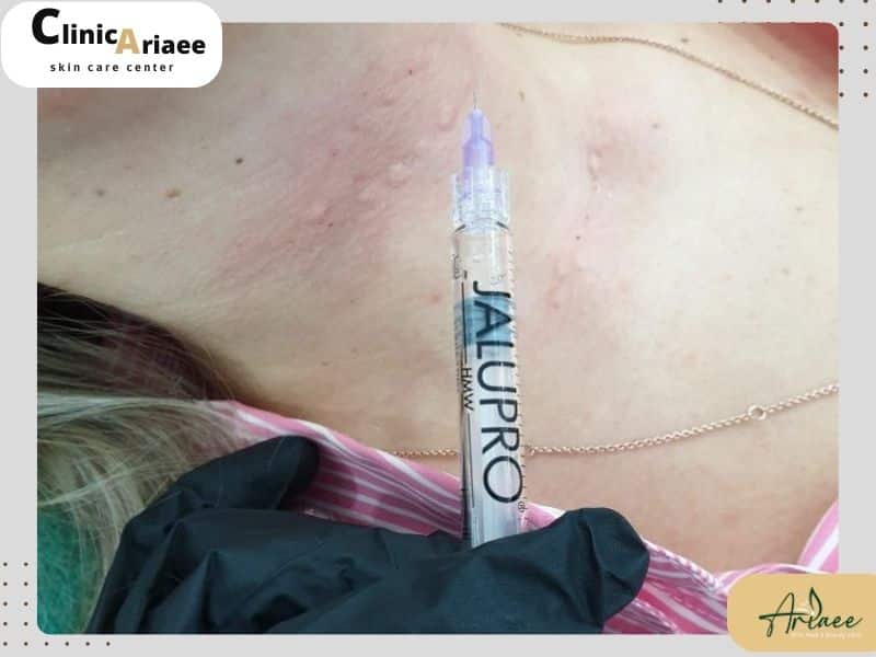 نحوه عملکرد مزوژل جالپرو چگونه است؟