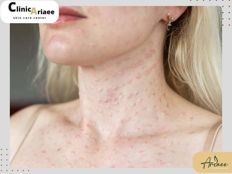 معایب تزریق چربی به صورت