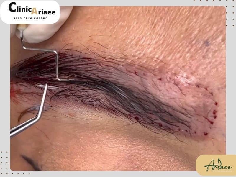 پیشگیری از عفونت ابرو بعد از کاشت