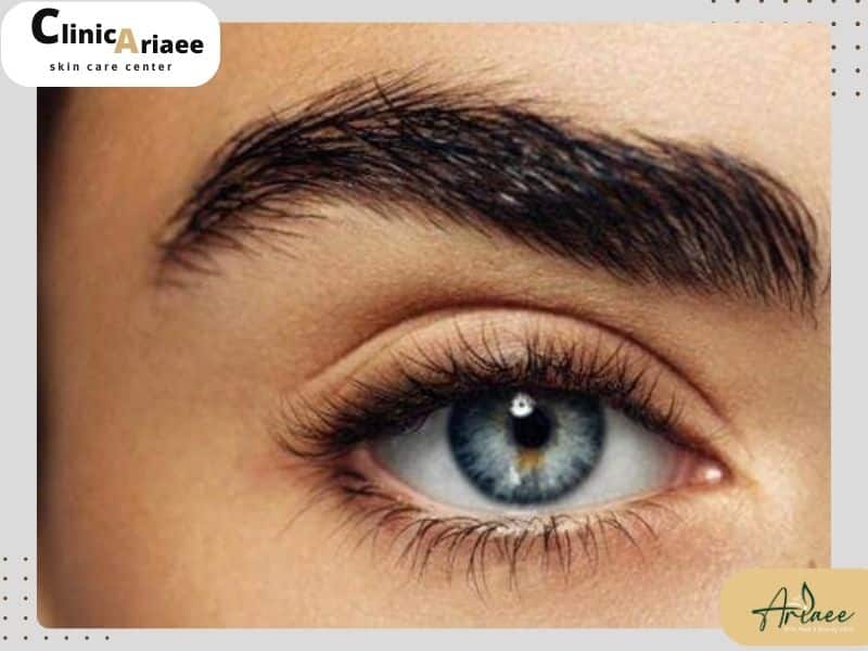 علل عفونت ابرو پس از کاشت