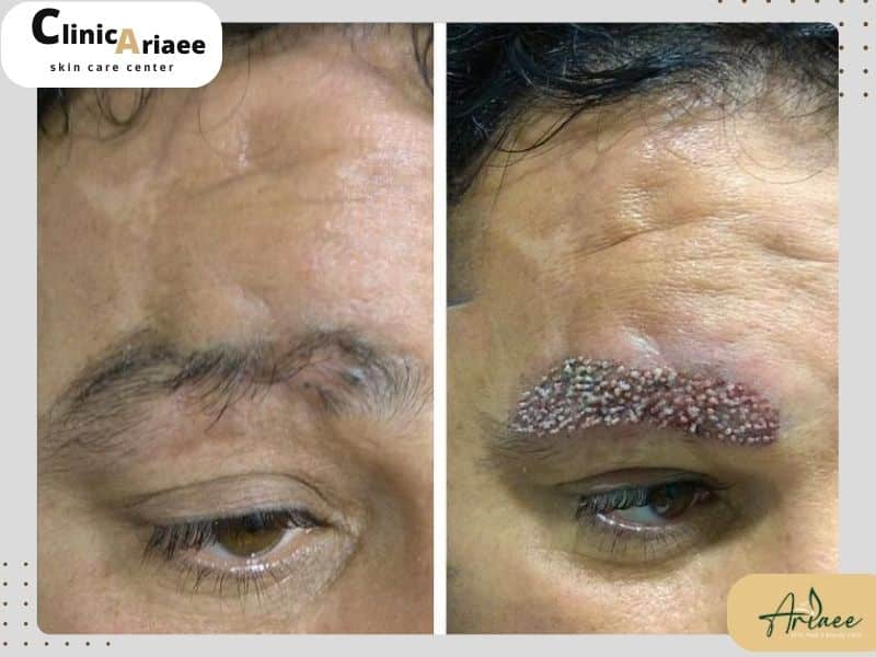علائم عفونت ابرو پس از کاشت