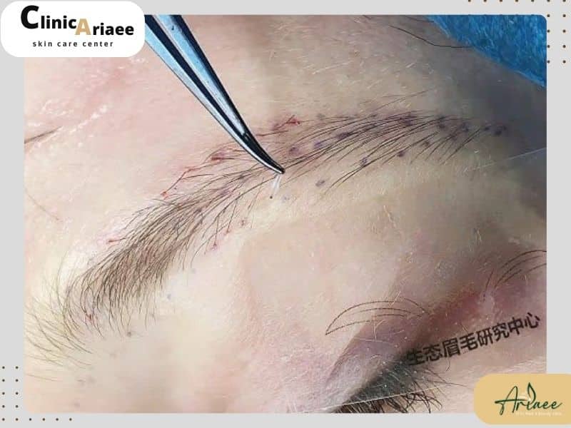  چالش‌های کاشت ابرو در ناحیه زخم و اسکار
