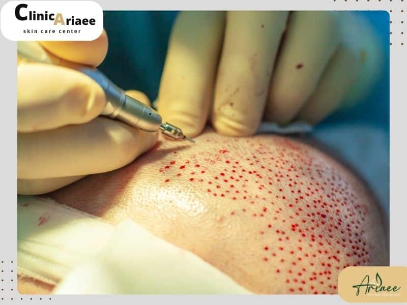 روش‌های کاشت مو بدون بانک مو
