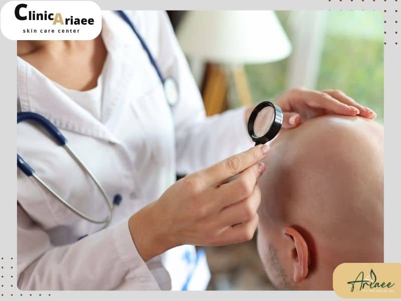 تأثیر بانک مو بر موفقیت کاشت مو