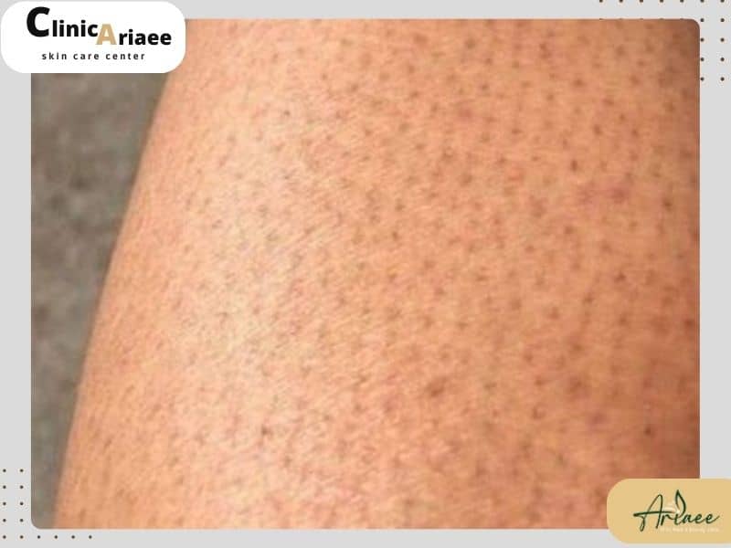 راهکارهای جلوگیری از بروز نقطه‌های ریز پوست و دیگر عوارض پس از لیزر