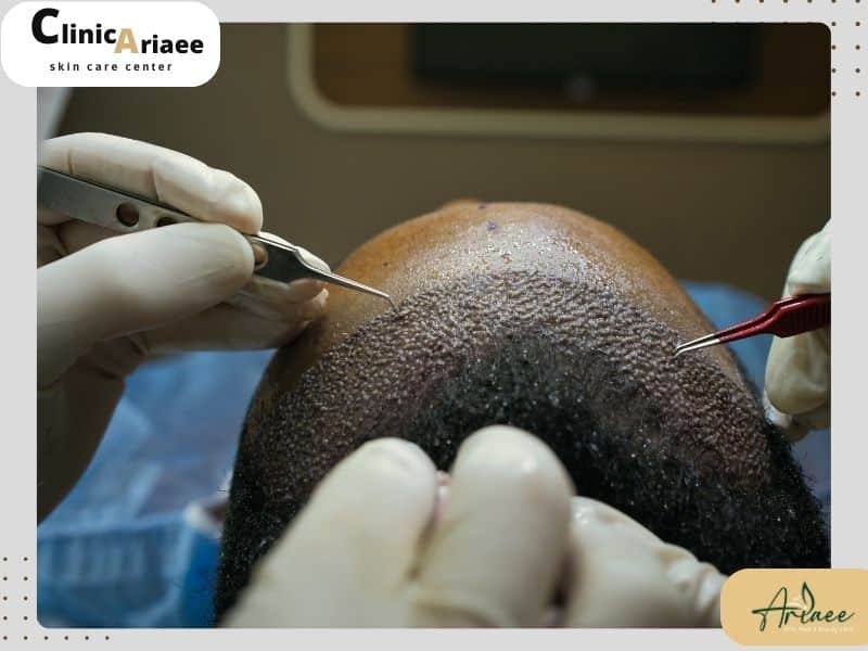  از چه زمانی می‌توان به موهای کاشته شده دست زد؟