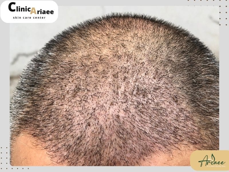 خطرات لمس موهای تازه کاشته شده