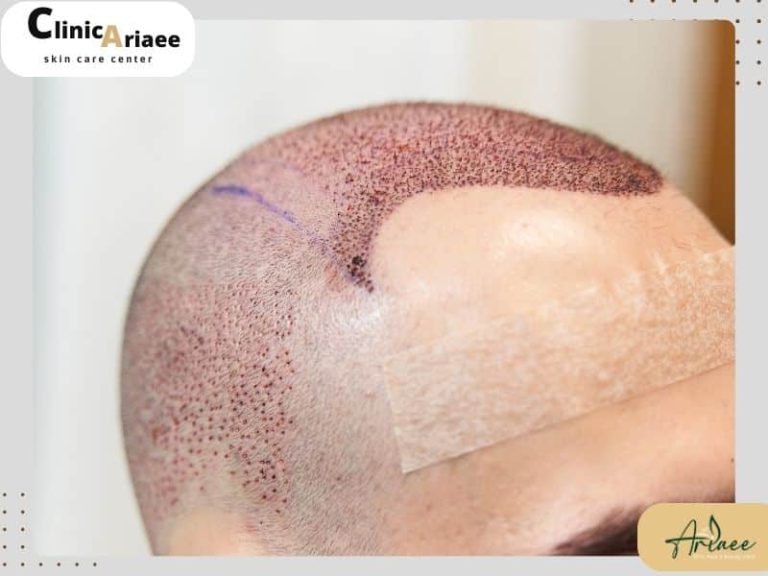  عوارض لمس موهای کاشته شده