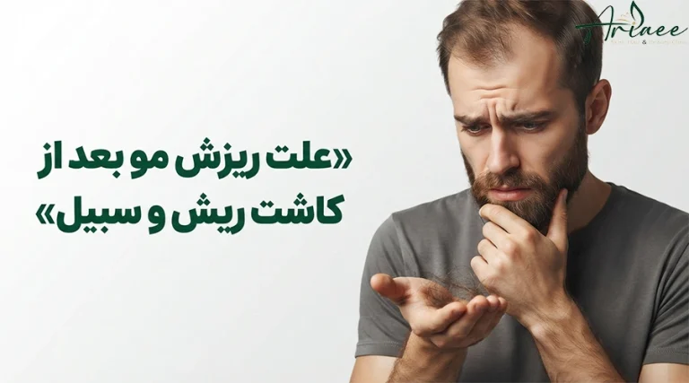 علت ریزش مو بعد از کاشت ریش و سبیل