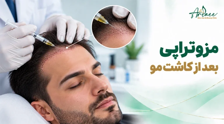 مزوتراپی بعد از کاشت مو